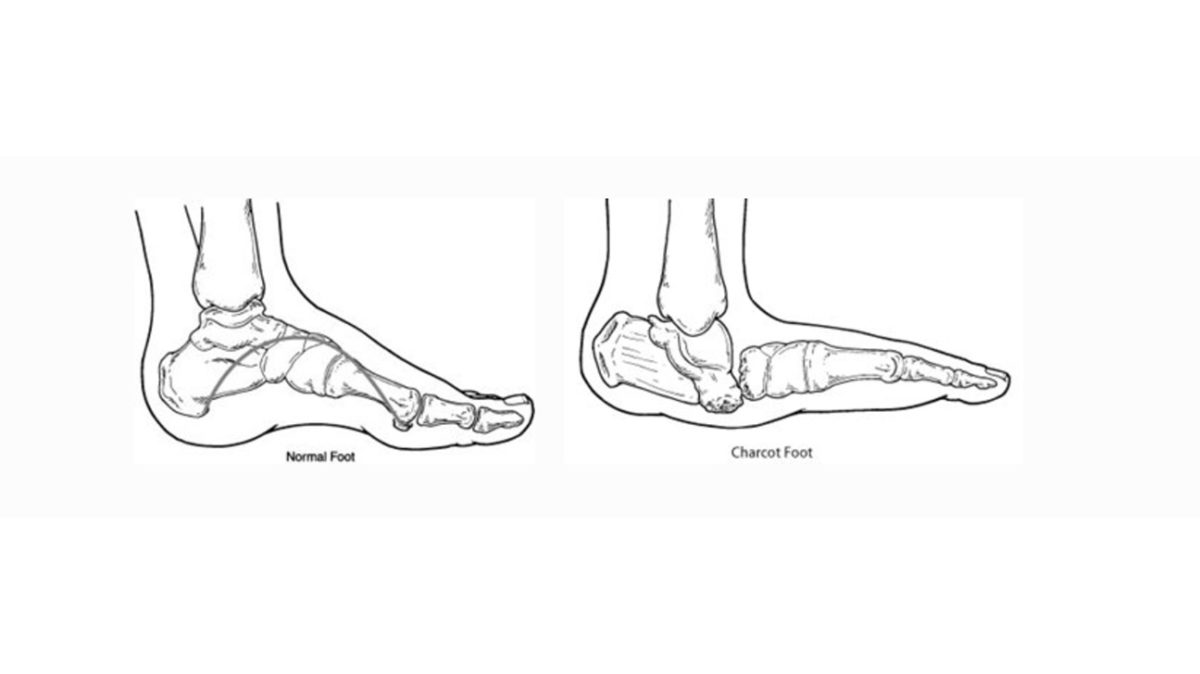 Charcot_Foot_Illustration